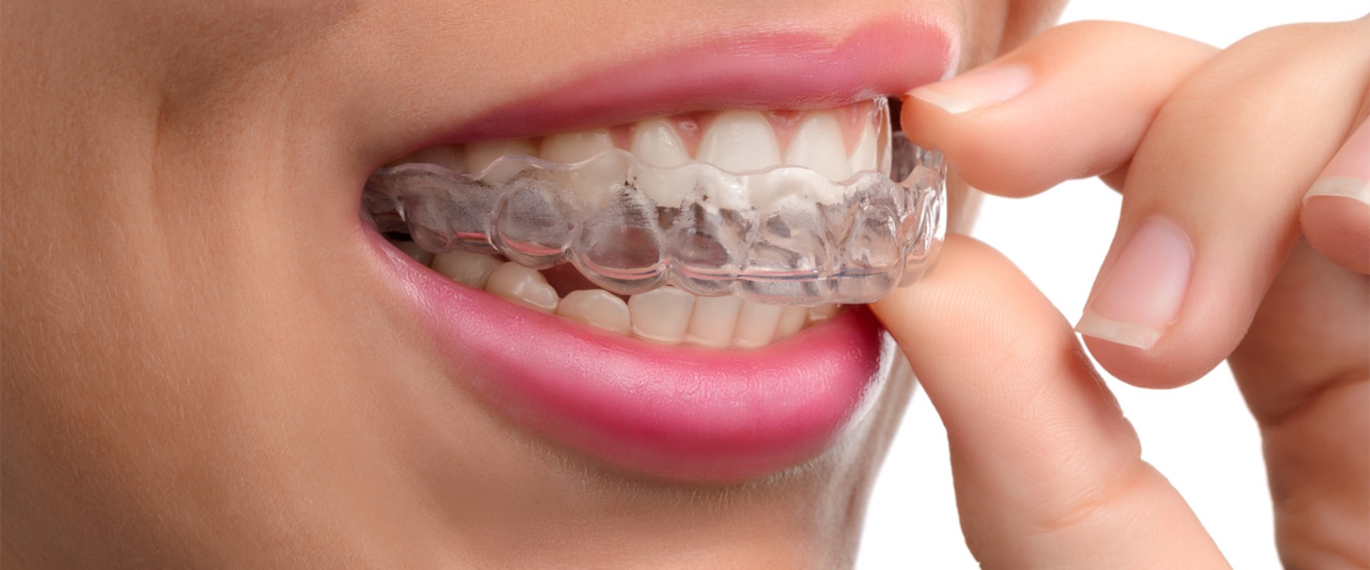 is-invisalign-covered-by-insurance-a-comprehensive-guide