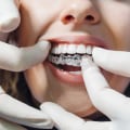 Do You Have to Wear Invisalign Forever?