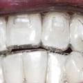 How Many Attachments Do You Need for Invisalign Treatment?