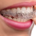 What Hurts More: Invisalign or Braces?