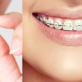 Is Invisalign Worse Than Braces? An Expert's Perspective