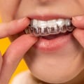Is Invisalign Safer Than Braces? An Expert's Perspective
