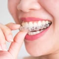 Can Invisalign Be Adjusted? A Comprehensive Guide