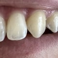 How to Safely Remove Invisalign Attachments