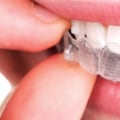 The History of Invisalign: From Stanford Students to Orthodontic Revolution