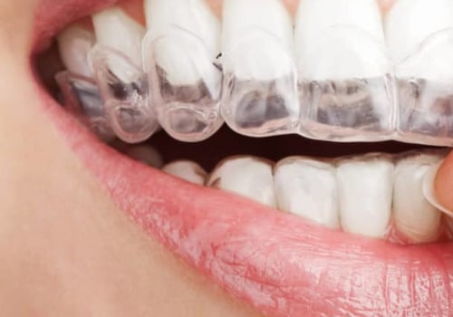 Which One is Faster: Braces or Invisalign?
