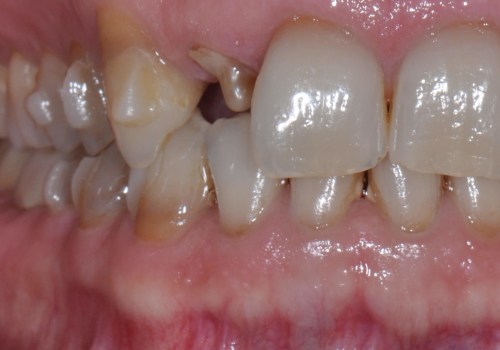 What Teeth Do Attachments Go On For Invisalign Treatment?