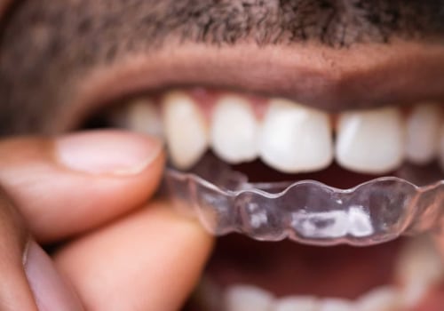 10 Things You Should Know Before Doing Invisalign Treatment