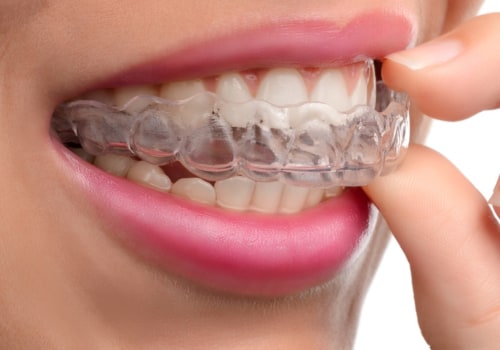 Is Invisalign Covered by Insurance? A Comprehensive Guide
