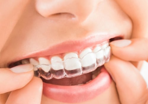 How Long Should You Wear Invisalign Braces For?