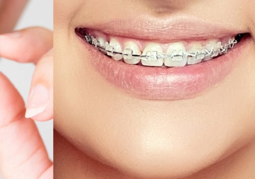 Do Orthodontists Prefer Braces or Invisalign?